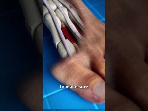 Bunion Correction 😨 (explained)